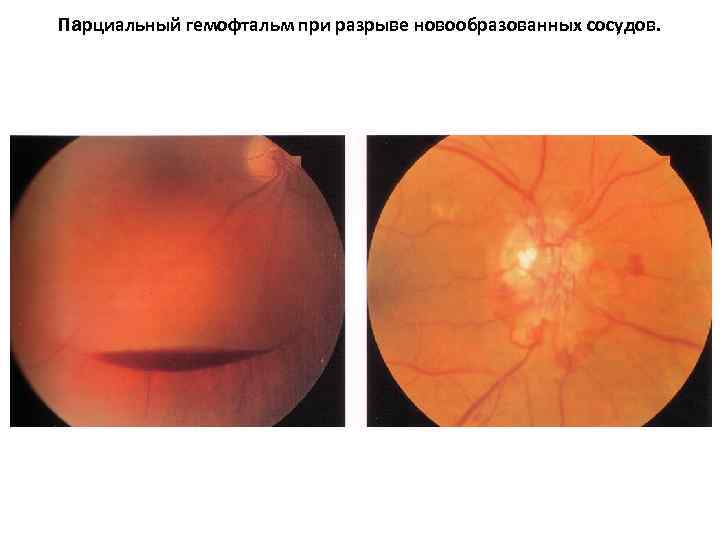 Парциальный гемофтальм при разрыве новообразованных сосудов. 