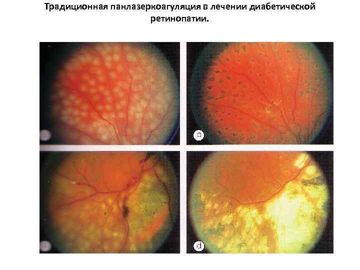Традиционная панлазеркоагуляция в лечении диабетической ретинопатии. 