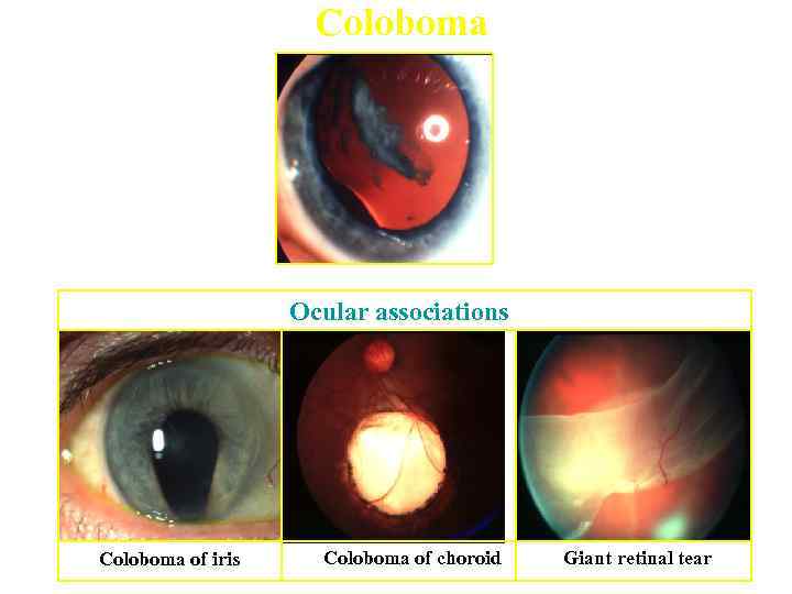 Coloboma Ocular associations Coloboma of iris Coloboma of choroid Giant retinal tear 