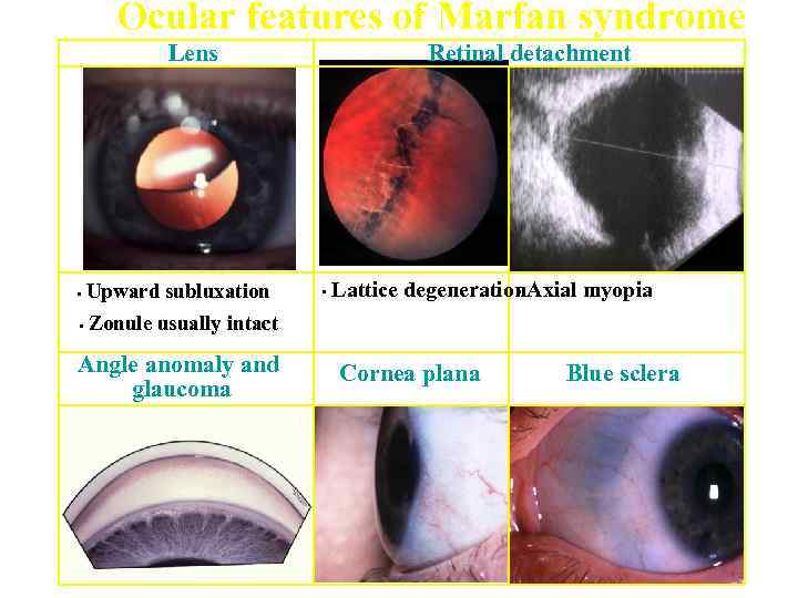Ocular features of Marfan syndrome Lens • Upward subluxation • Retinal detachment Lattice degeneration.