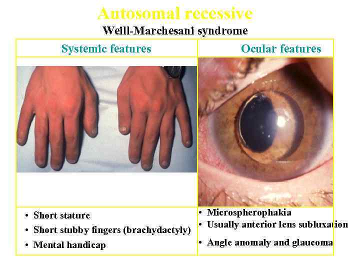 Autosomal recessive Weill-Marchesani syndrome Systemic features Ocular features • Microspherophakia • Short stature •