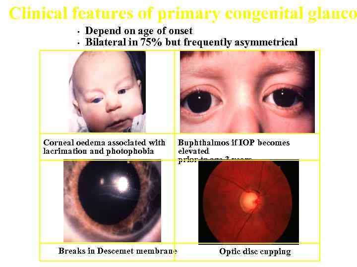 Clinical features of primary congenital glauco • • Depend on age of onset Bilateral
