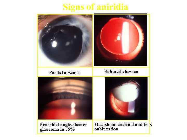 Signs of aniridia Partial absence Synechial angle-closure glaucoma in 75% Subtotal absence Occasional cataract