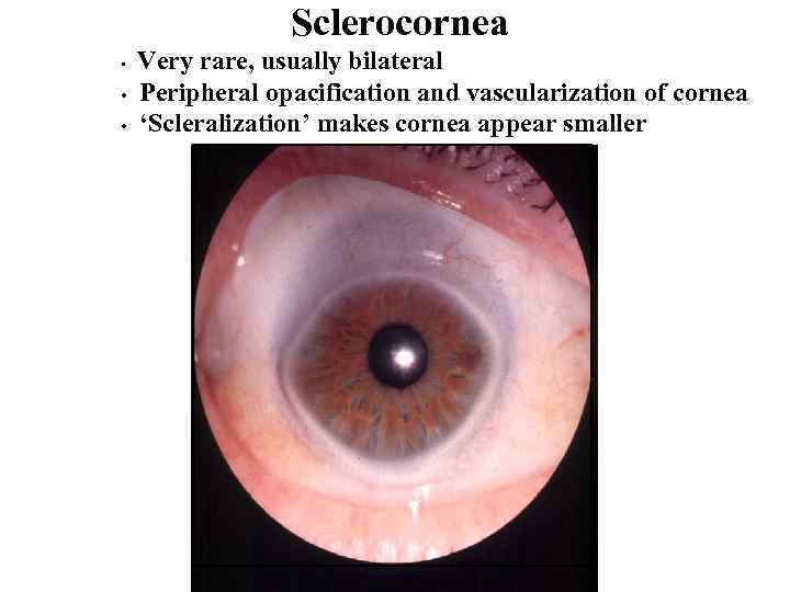 Sclerocornea • • • Very rare, usually bilateral Peripheral opacification and vascularization of cornea