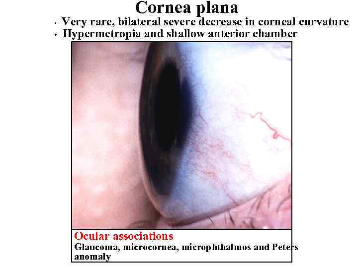 Cornea plana • • Very rare, bilateral severe decrease in corneal curvature Hypermetropia and