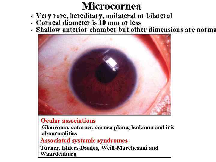 Microcornea • • • Very rare, hereditary, unilateral or bilateral Corneal diameter is 10