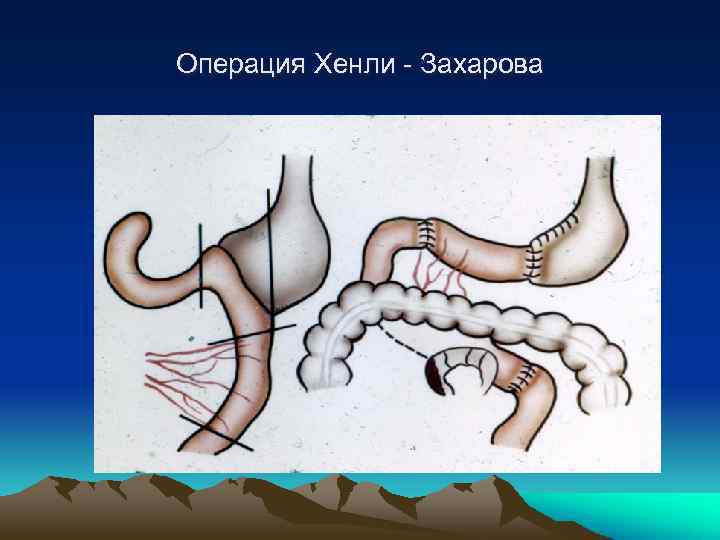 Постваготомический синдром презентация