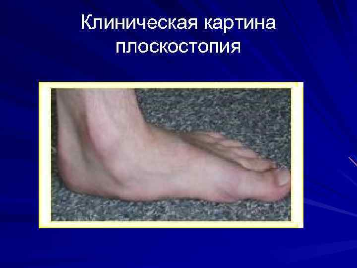 Клиническая картина плоскостопия 