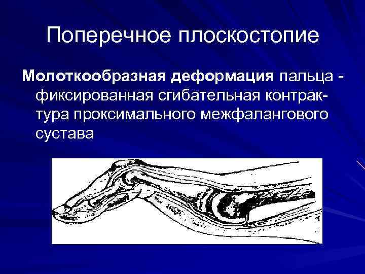 Поперечное плоскостопие Молоткообразная деформация пальца фиксированная сгибательная контрактура проксимального межфалангового сустава 