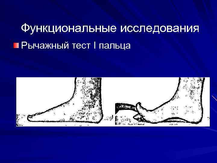Функциональные исследования Рычажный тест I пальца 