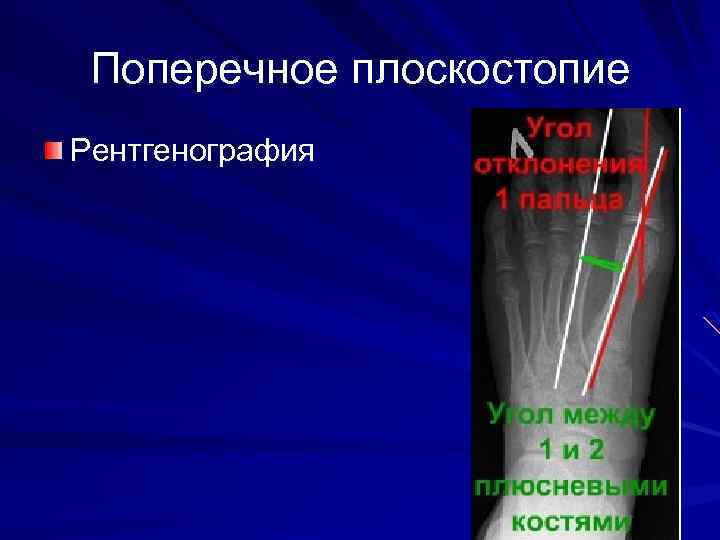 Поперечное плоскостопие Рентгенография 
