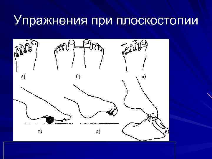 Упражнения при плоскостопии 