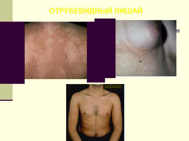 ОТРУБЕВИДНЫЙ ЛИШАЙ 