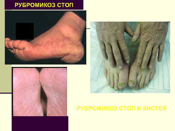 РУБРОМИКОЗ СТОП И КИСТЕЙ 