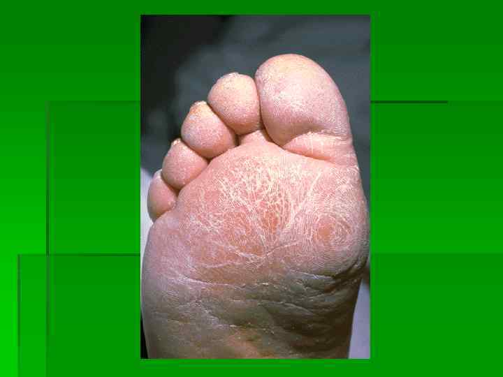 Грибковые заболевания кожи классификация симптомы принципы лечения тела и фото