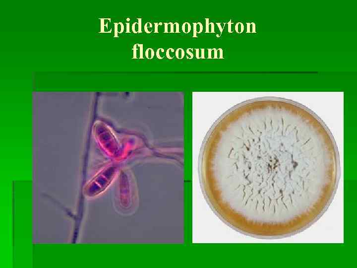 Epidermophyton floccosum 