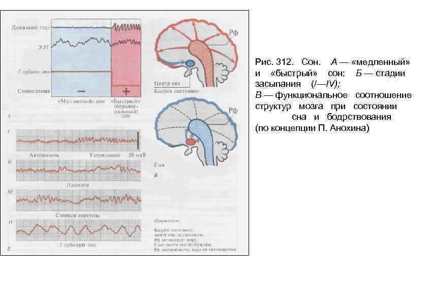 Рис. 312. Сон. А — «медленный» и «быстрый» сон; Б — стадии засыпания (/—IV);