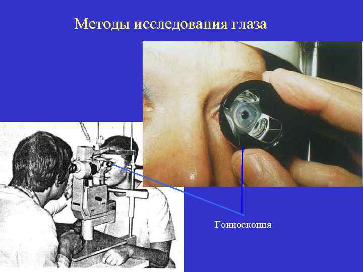 Методы исследования глаза Гониоскопия 