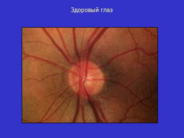 Здоровый глаз 