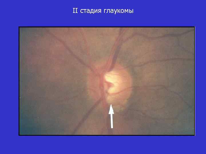 II стадия глаукомы 