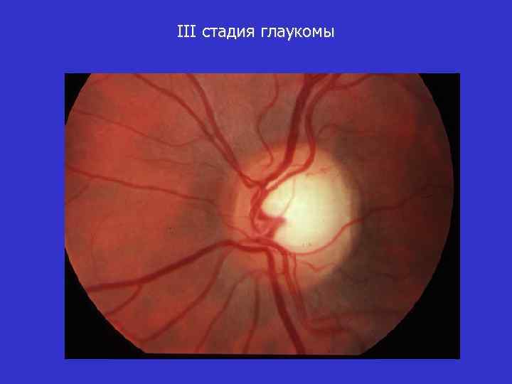 III стадия глаукомы 