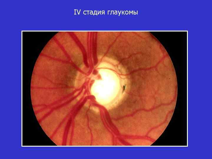 IV стадия глаукомы 