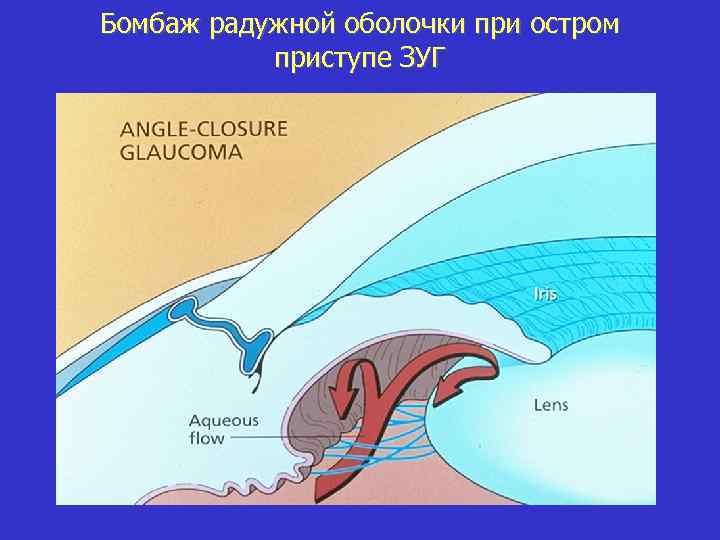 Бомбаж радужной оболочки при остром приступе ЗУГ 