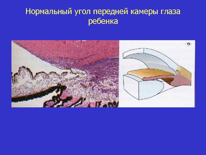 Нормальный угол передней камеры глаза ребенка 