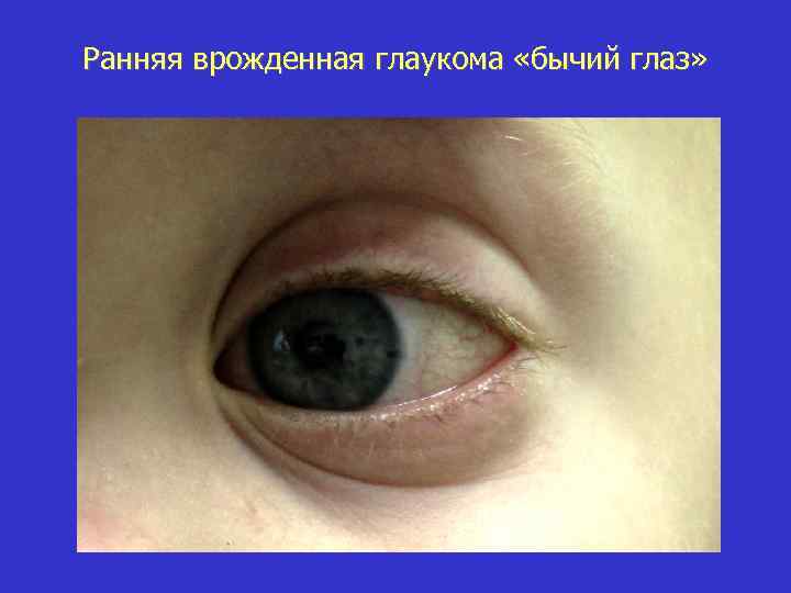 Ранняя врожденная глаукома «бычий глаз» 
