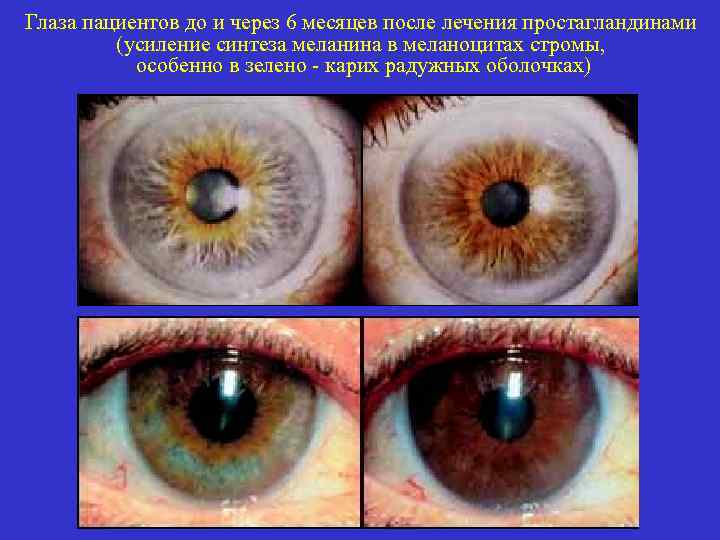 Глаза пациентов до и через 6 месяцев после лечения простагландинами (усиление синтеза меланина в