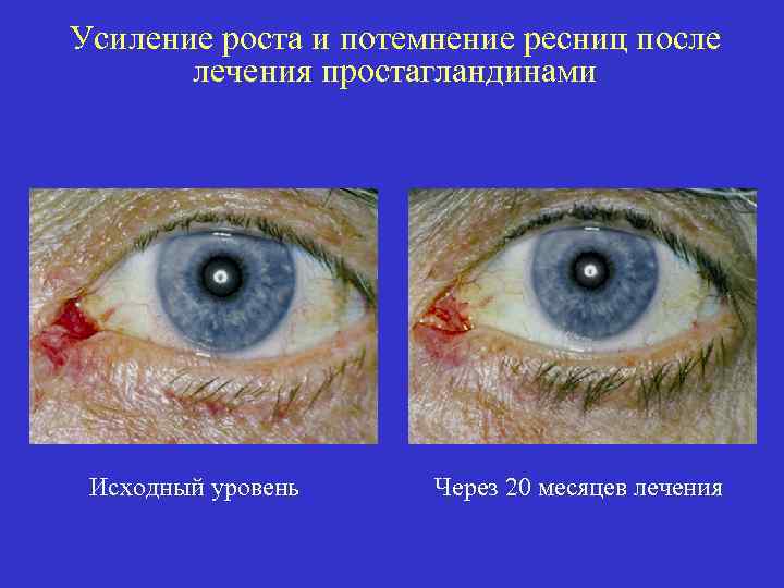 Усиление роста и потемнение ресниц после лечения простагландинами Исходный уровень Через 20 месяцев лечения