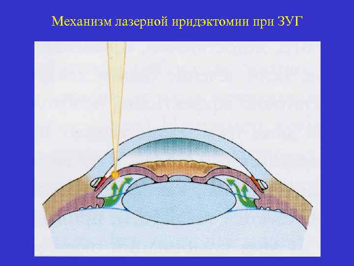 Механизм лазерной иридэктомии при ЗУГ 