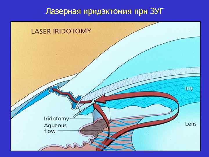 Лазерная иридэктомия