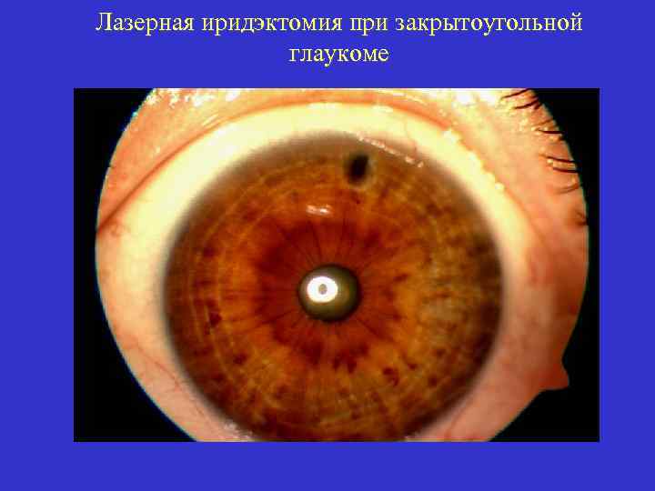 Лазерная иридэктомия при закрытоугольной глаукоме 