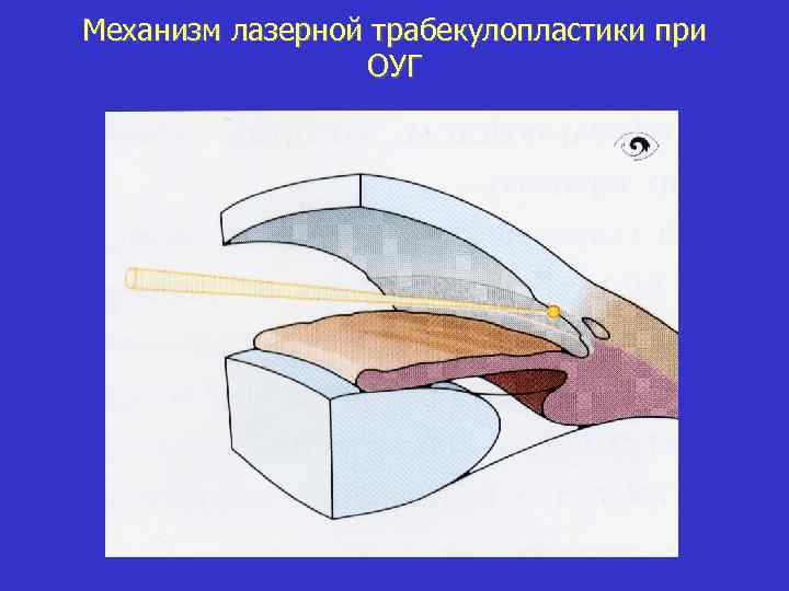 Механизм лазерной трабекулопластики при ОУГ 