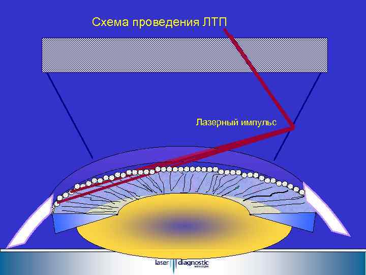 Схема проведения ЛТП Лазерный импульс 