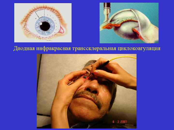 Диодная инфракрасная транссклеральная циклокоагуляция 