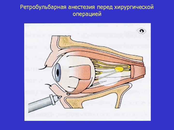 Ретробульбарная анестезия перед хирургической операцией 