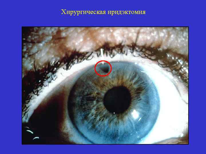Хирургическая иридэктомия 