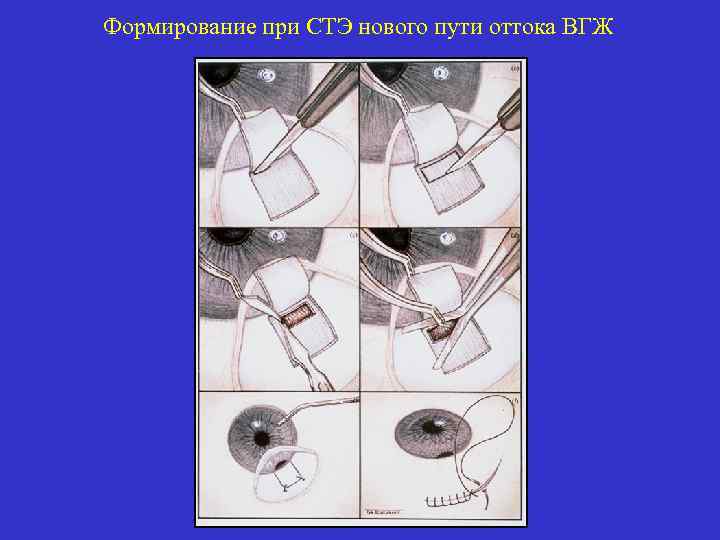 Формирование при СТЭ нового пути оттока ВГЖ Синустрабекулоэктомия 