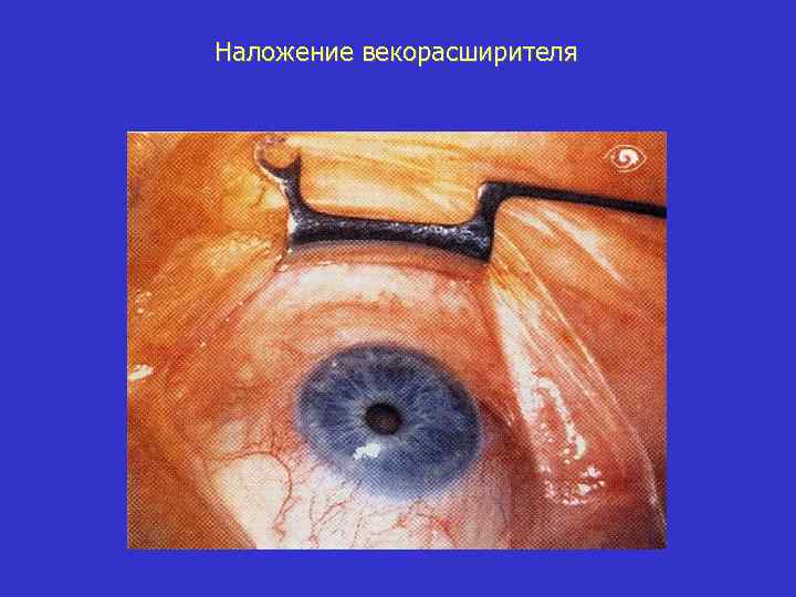 Наложение векорасширителя 