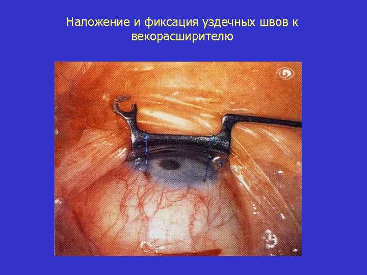 Наложение и фиксация уздечных швов к векорасширителю 