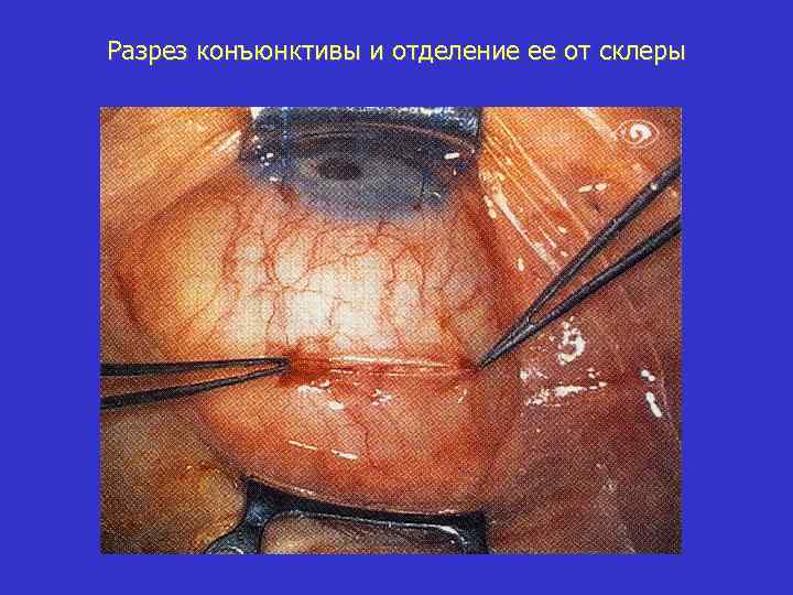 Разрез конъюнктивы и отделение ее от склеры 