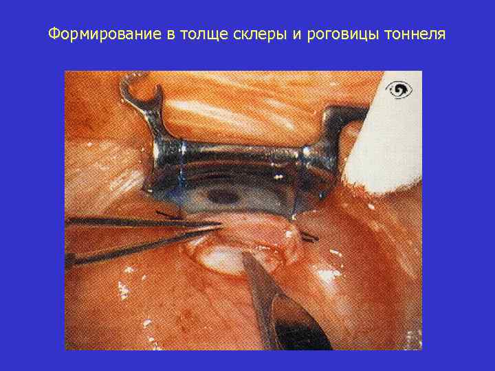 Формирование в толще склеры и роговицы тоннеля 