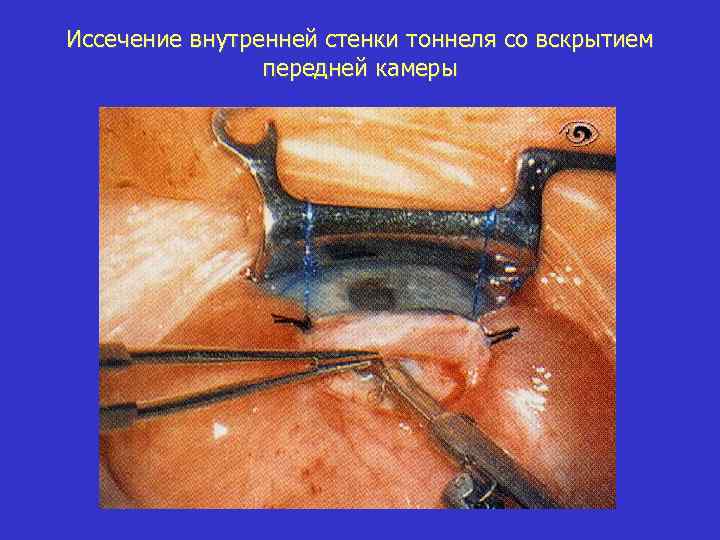 Иссечение внутренней стенки тоннеля со вскрытием передней камеры 