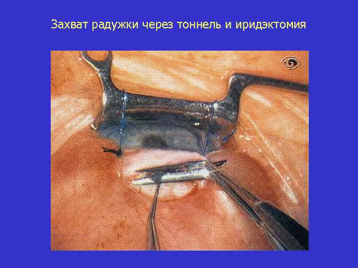 Захват радужки через тоннель и иридэктомия 