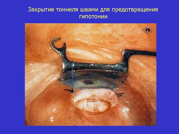 Закрытие тоннеля швами для предотвращения гипотонии 