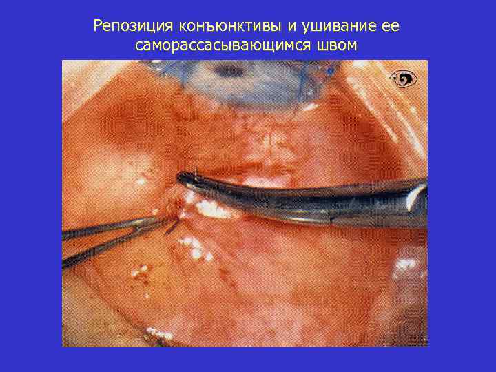 Репозиция конъюнктивы и ушивание ее саморассасывающимся швом 