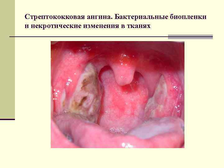 Стрептококковая ангина. Бактериальные биопленки и некротические изменения в тканях 