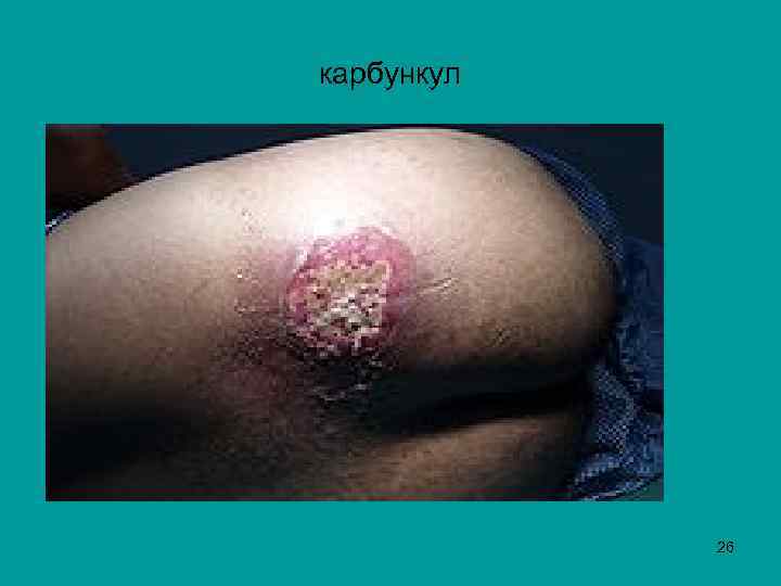 карбункул 26 